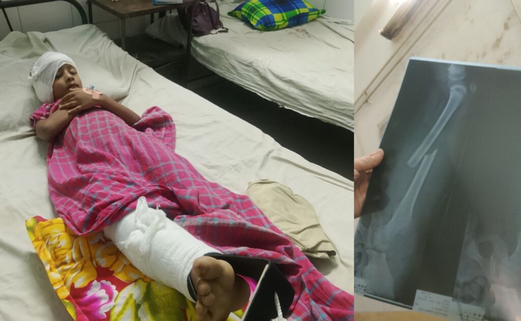 বরুড়ায় বলাকা বাসের ধাক্কায় আহত শিশু জিয়া উদ্দীন বেঁচে আছে: চালকের বিরুদ্ধে অভিযোগের প্রস্তুতি বাবার